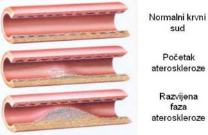 Arterioskleroza